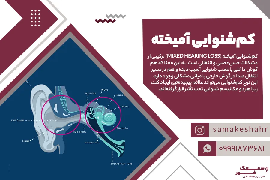 محل ابتلا به کم شنوایی آمیخته در آناتومی گوش